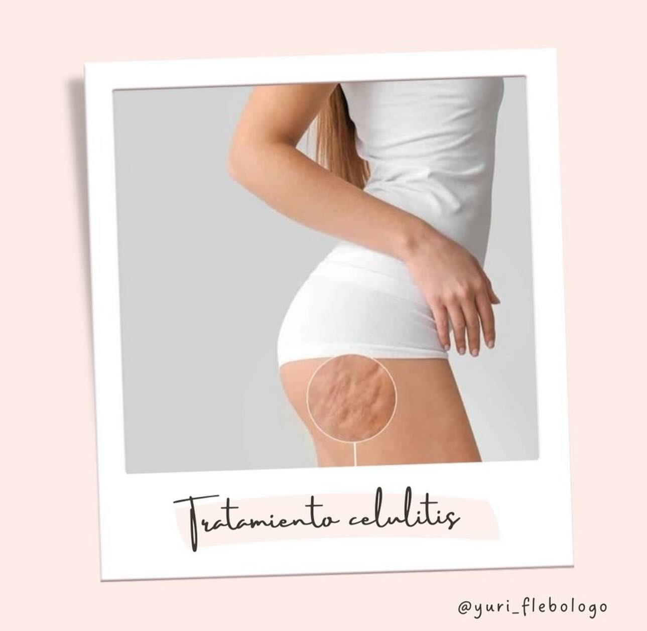 Tratamiento corporal